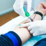 Laboratory technician handling a blood sample for multi-cancer screening test